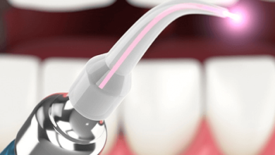dental laser cleaning