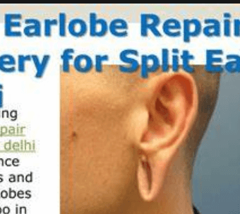 earlobe repair cost